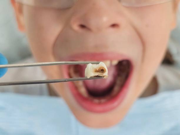 Best Emergency Dental Care for Broken or Chipped Teeth in King, WI