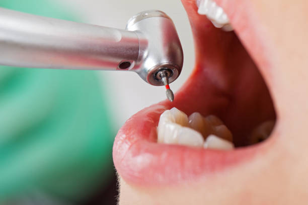 Best Emergency Tooth Extraction in King, WI